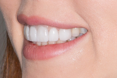 Primer plano de una sonrisa con los labios hidratados